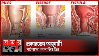 পাইলস ফিসার ও ফিস্টুলার মধ্যে পার্থক্য কী  Piles  Fissure  Fistula  Somoy TV [upl. by Dine]