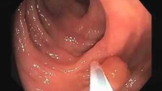 Colonoscopy Video Tour Removal of a Colon Polyp Polypectomy [upl. by Ahtnammas]