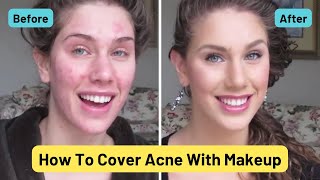 Foundation Routine For Acne  How To Cover Pimples Scars Cystic Acne Blackheads amp Oil [upl. by Rozelle]