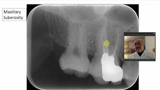 Area of upper molars Coronoid process [upl. by Yahsram]