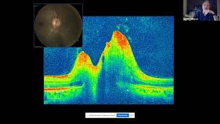 OCT in Neuro ophthalmic Disorders [upl. by Edwyna]