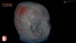 Resection of Brain Stem Cavernoma Minimally Invasive Surgery [upl. by Mayworm]