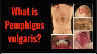 What is PEMPHIGUS VULGARIS Symptoms Causes [upl. by Mayor]