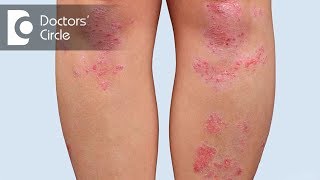 All about Psoriasis  Dr Govind Mittal [upl. by Lange]