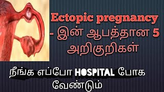 ectopic pregnancy symptoms in tamil  pregnancy symptoms in tamil  Puguntha veedu [upl. by Ddart]