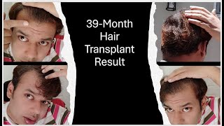 39 Months Hair Transplant result Hindi  KV Life in USA [upl. by Anyel]