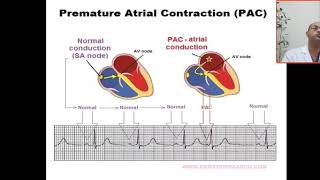 How to differentiate between premature atrial PAC and ventricular PVC contraction  PORS ectopic [upl. by Kaplan]