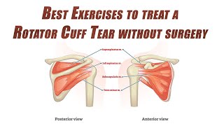 Best SelfTreatment of a Rotator Cuff Tear  Shoulder Rehab without Surgery [upl. by Eiramnaej]