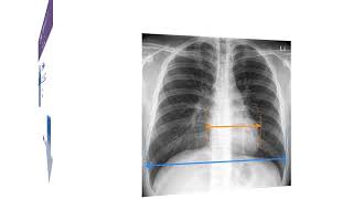 Cardiothoracic ratio CTR in Chest X ray and CT [upl. by Tireb]