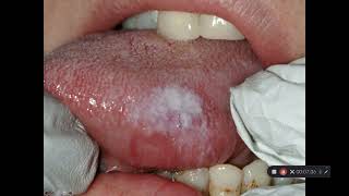 Oral cancer and precancer part 3 Leukoplakia and Erythroplakia [upl. by Noek219]