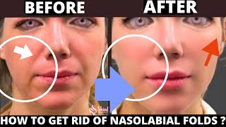 🛑 HOW TO GET RID OF NASOLABIAL FOLDS WITH FACE YOGA  JOWLS SAGGY SKIN FOREHEAD TURKEY NECK CHIN [upl. by Gordie]