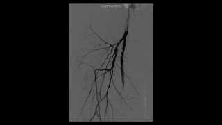 Comprehensive Review in Vascular and Endovascular Medicine  Video 141 [upl. by Kirit]