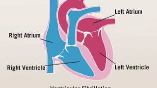 Ventricular Fibrillation [upl. by Daza]