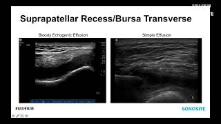 Webinar Ultrasound Evaluation of the Anterior Knee [upl. by Kone]