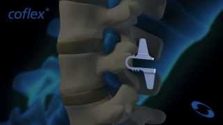 coflex® NonFusion Implant in Flexion and Extension  Paradigm Spine [upl. by Hsirahc424]