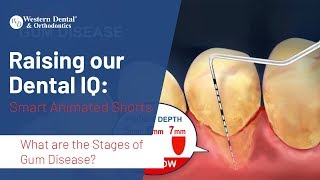 What are the Stages of Gum Disease  Western Dental [upl. by Shuma]