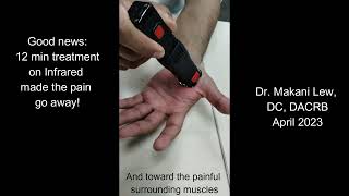 Sprained index finger treatment with laser [upl. by Tennaj8]