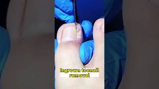 Trimming ingrown toenail toenails satisfying pedicure foot [upl. by Ttesil]