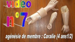 agénésie Coralie 4 ans 12  vidéo n°7 [upl. by Ahgiela]