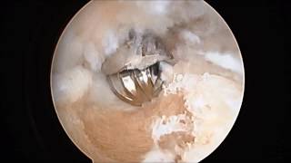 Calcaneoplasty Arthroscopic Surgery for Removal Haglunds Deformity for Heel Pain SFISM [upl. by Roddy391]