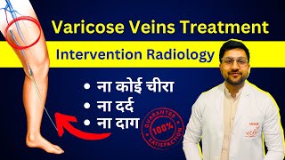 Varicose Veins Treatment Without Surgery  Laser amp Venaseal  बिना ऑपरेशन कैसे ठीक करें IR [upl. by Fabyola193]