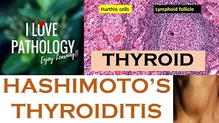 HASHIMOTOS THYROIDITIS Etiopathogenesis Morphology amp Complications [upl. by Nedyah314]