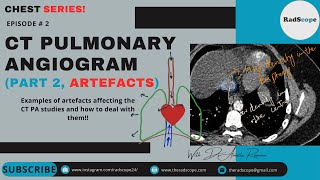 CT Pulmonary Angiogram Part 2 Artefacts [upl. by Ryle]