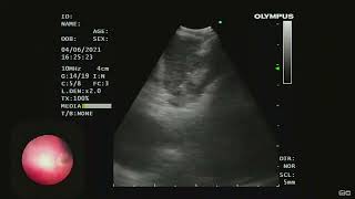 Mediastenal NUT cell carcinoma  Endobronchial Ultrasound EBUS [upl. by Aicilana]