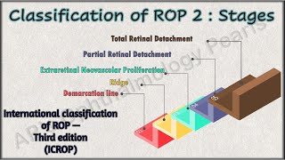 Classification of ROP 2  Stages [upl. by Jedthus680]