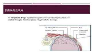 Intrapleural Route of Drug Administration  Purpose Why it is done and Procedure [upl. by Darius]