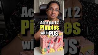 How To Treat Pus Filled Acne At Home  Papules amp Pustules trending [upl. by Umont]