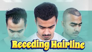 Hair Transplant in Dhaka A Case Study for Receding Hairlines 😊  New Roots [upl. by Ecar525]