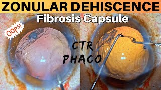 Zonular Dehiscence Noted during Phacoemulsification Management strategies  Dr Deepak Megur [upl. by Oscar]