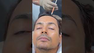 Trichometric PRP Hair Treatment to Deal With Hair Loss [upl. by Magel987]