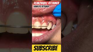 Hawley’s Retainer  Orthodontic Treatment at Delhi 5 Dental Clinic explore delhidentist shorts [upl. by Ynnaf]