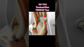 Learn about Tendon Tear tips foryou exercises physiotherapy physiotherapist doctor heelpain [upl. by Monjo492]