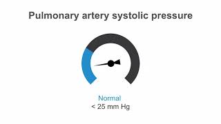 How to estimate pulmonary artery systolic pressure PASP using echo [upl. by Rise962]