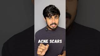 How to treat acne scars ✅ skintransformation youtubeshortsindia telugushorts [upl. by Ajtak]