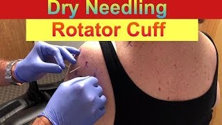 Dry Needling Rotator Cuff [upl. by Aggarwal]