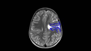 Bilateral schizencephaly  open and closed lip [upl. by Adnawat]