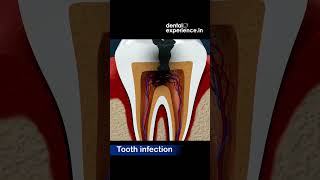 Tooth infection  Abscess  Caries  Symptoms  Treatments  Dentalexperiencein [upl. by Nivat]