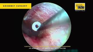 Myringotomy with grommet insertion [upl. by Zenda]