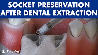 Tooth extraction  Treatment for socket preservation © [upl. by Eidob]