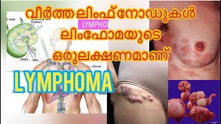 LYMPHOMA മിക്ക ലിംഫോമകളും കീമോതെറാപ്പിയിലൂടെയും ടാർഗെറ്റഡ് തെറാപ്പിയിലൂടെയും സുഖപ്പെടുത്താവുന്നതാണ് [upl. by Breskin]