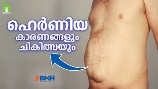 ഹെർണിയ വരാനുള്ള പ്രധാന കാരണം  Hernia Malayalam Health Tips [upl. by Upshaw154]