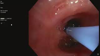 Cryolung biopsy  Endobronchial blocker [upl. by Aleta]