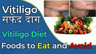 Vitiligo Diet l Foods to Eat in Vitiligo l Foods to avoid in Vitiligo  How to cure Vitiligo [upl. by Ahsii112]