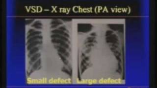 Acyanotic Congenital Heart Disease Shunt Lesions [upl. by Hnirt]