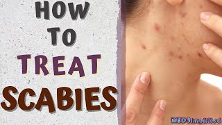 HOW TO TREAT SCABIESscabies treatment at home [upl. by Dix]