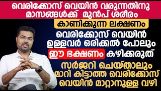 വെരിക്കോസ് വെയിൻ ഉള്ളവർ ഒരിക്കൽ പോലും ഈ ഭക്ഷണം കഴിക്കരുത്  Varicose veins Malayalam [upl. by Ecienaj]